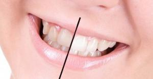 Dişlerin Beyazlaması İçin Öneriler 