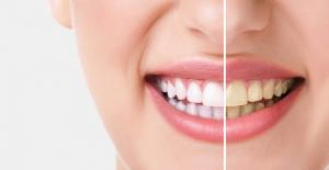 Diş Beyazlatma Nedir? Nasıl Yapılır?