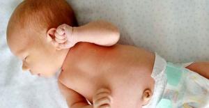 Bebeklerde Fıtık Ameliyatı Ne Kadar Sürer?