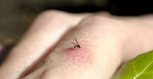 Sivrisinek Isırığına Ne İyi Gelir?