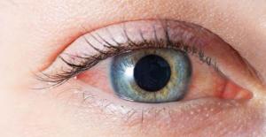 Göz Kızarıklığı ve Kaşıntı Koronavirüs Belirtisi midir?