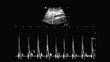 ultrason görüntüsü
